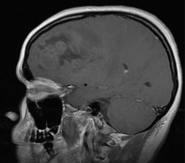 MRT Kopf sagittal T1 KM