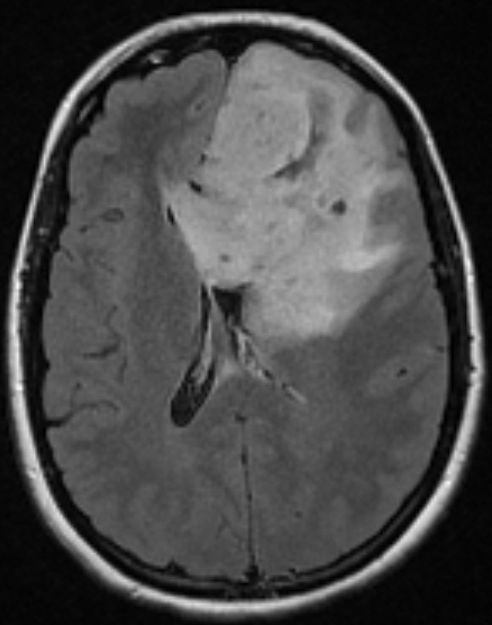 MRT Kopf axial FLAIR